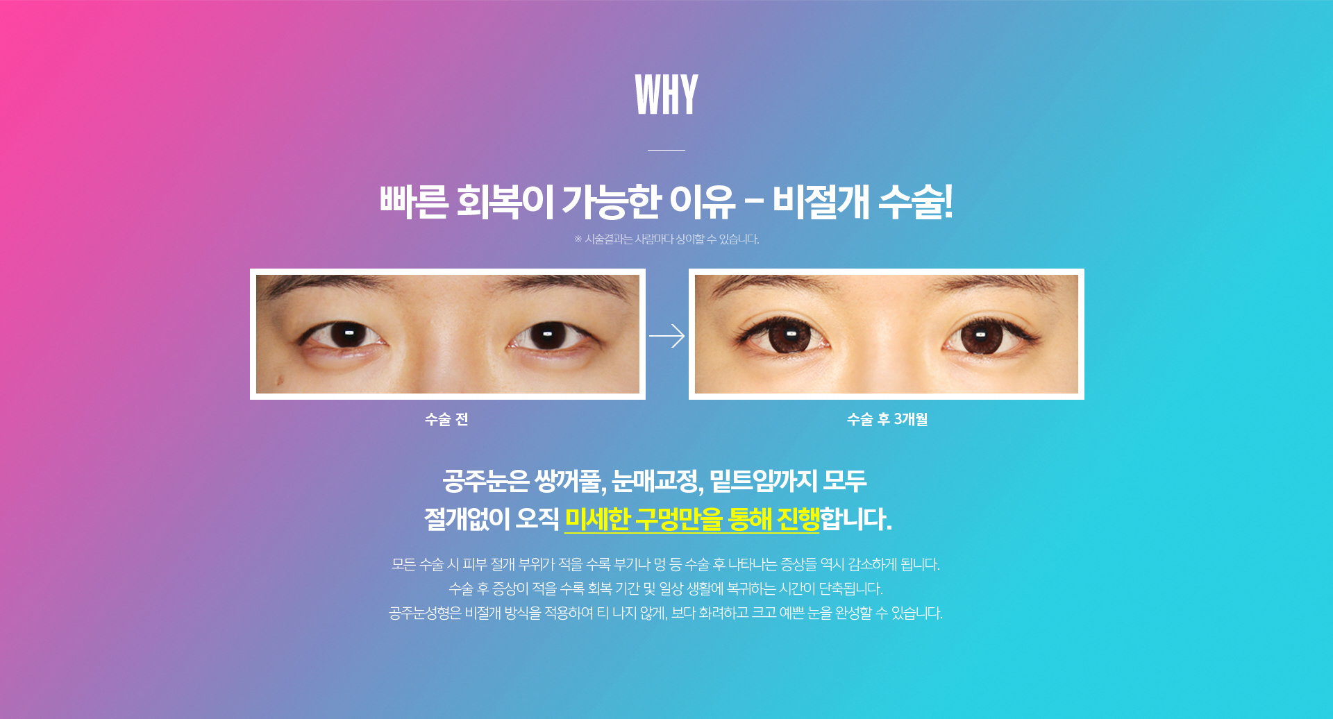 공주눈 패키지 추천 대상 안내 - 크고 또렷하면서도 자연스러운 눈매를 원하는 분께 적합