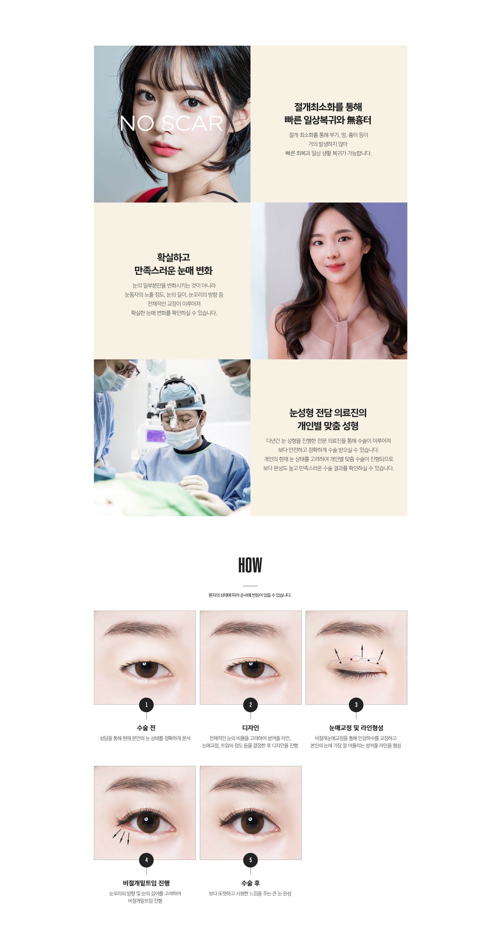 라프린 공주눈 패키지 비절개 수술 방법 상세 설명