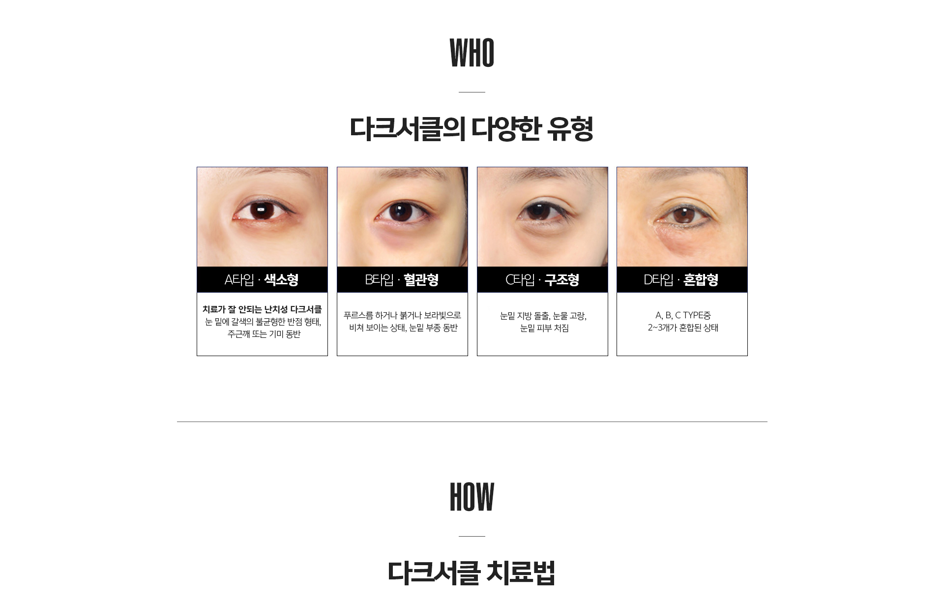 눈밑 시술 종류 비교 – 눈밑지방제거술, 눈밑지방이식술, 눈밑지방재배치, 비수술 레이저 치료, 나노팻 이식 비교 안내
