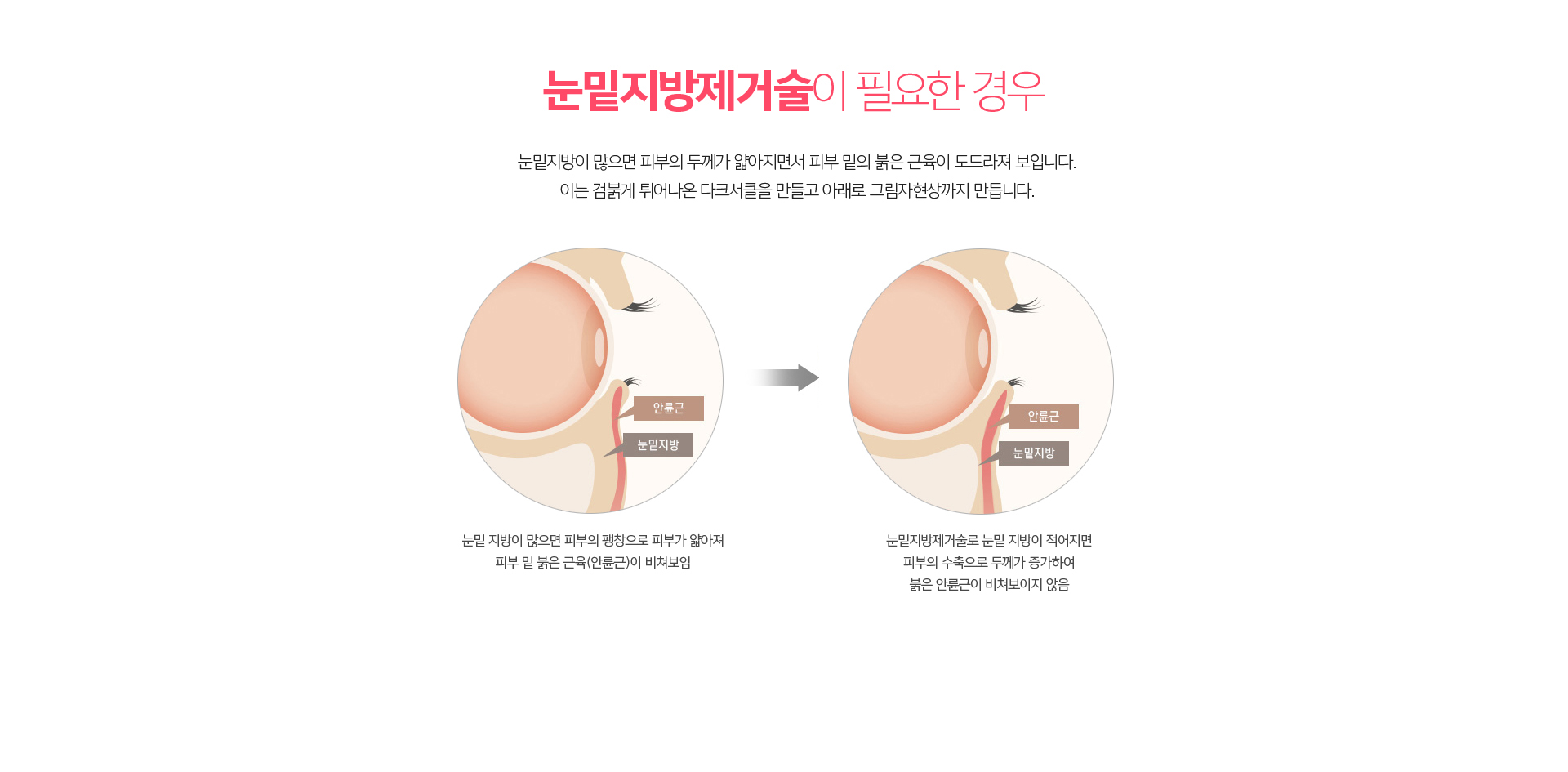눈밑지방제거술 – 돌출된 눈밑지방을 절제해 눈밑 불룩함을 개선하는 시술 방법 안내
