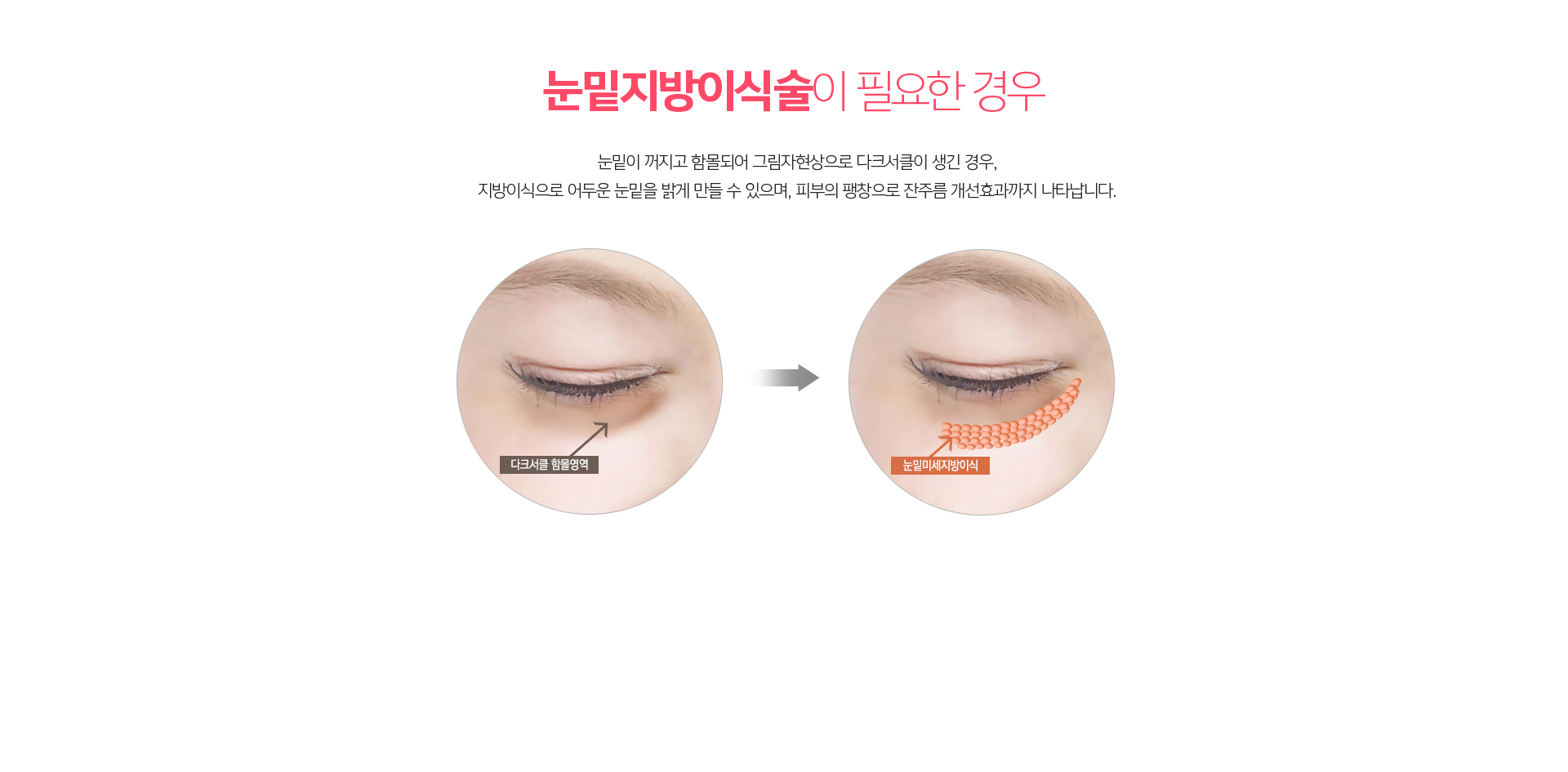 눈밑지방이식술 – 꺼진 눈밑과 눈물고랑에 자가지방을 이식해 볼륨을 채우는 시술 방법 안내