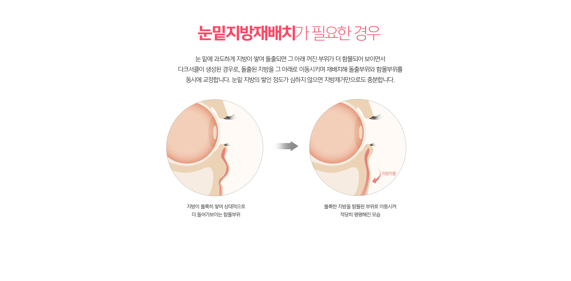 눈밑지방재배치 시술 과정 – 돌출 지방을 꺼진 눈물고랑으로 옮겨 자연스러운 눈밑 라인을 완성하는 수술 방법 상세 안내