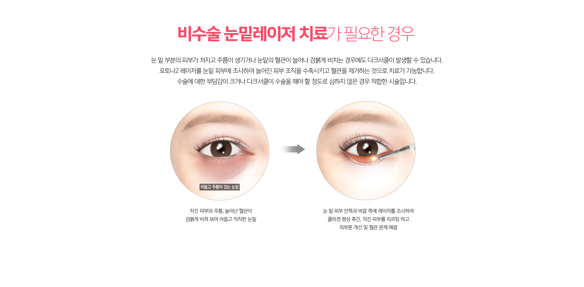 비수술 눈밑레이저 치료 – 절개 없이 레이저로 눈밑 색소와 탄력을 개선하는 다크서클 치료 안내