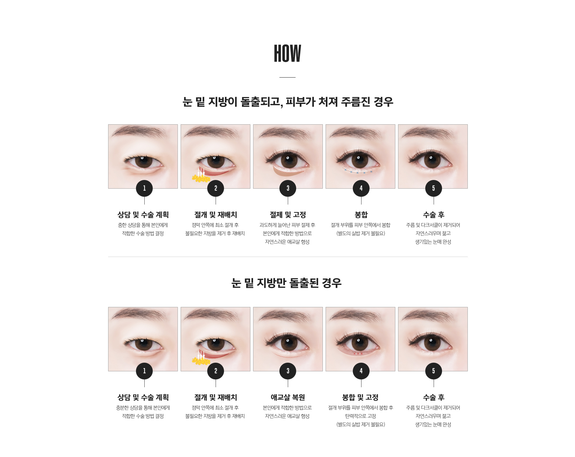 중안면거상 수술 후 회복 과정 – 수술 후 붓기 관리, 일상 복귀 기간, 동안 효과 지속기간 안내