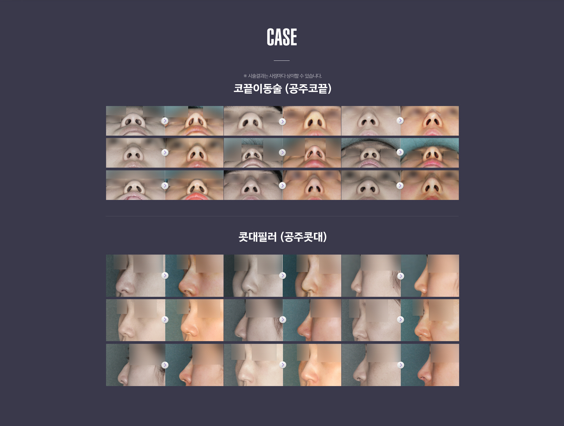 공주코 적응증 - 처진 코끝, 화살코, 웃을 때 코끝 내려감, 콧볼 넓어 보이는 코 교정 사례