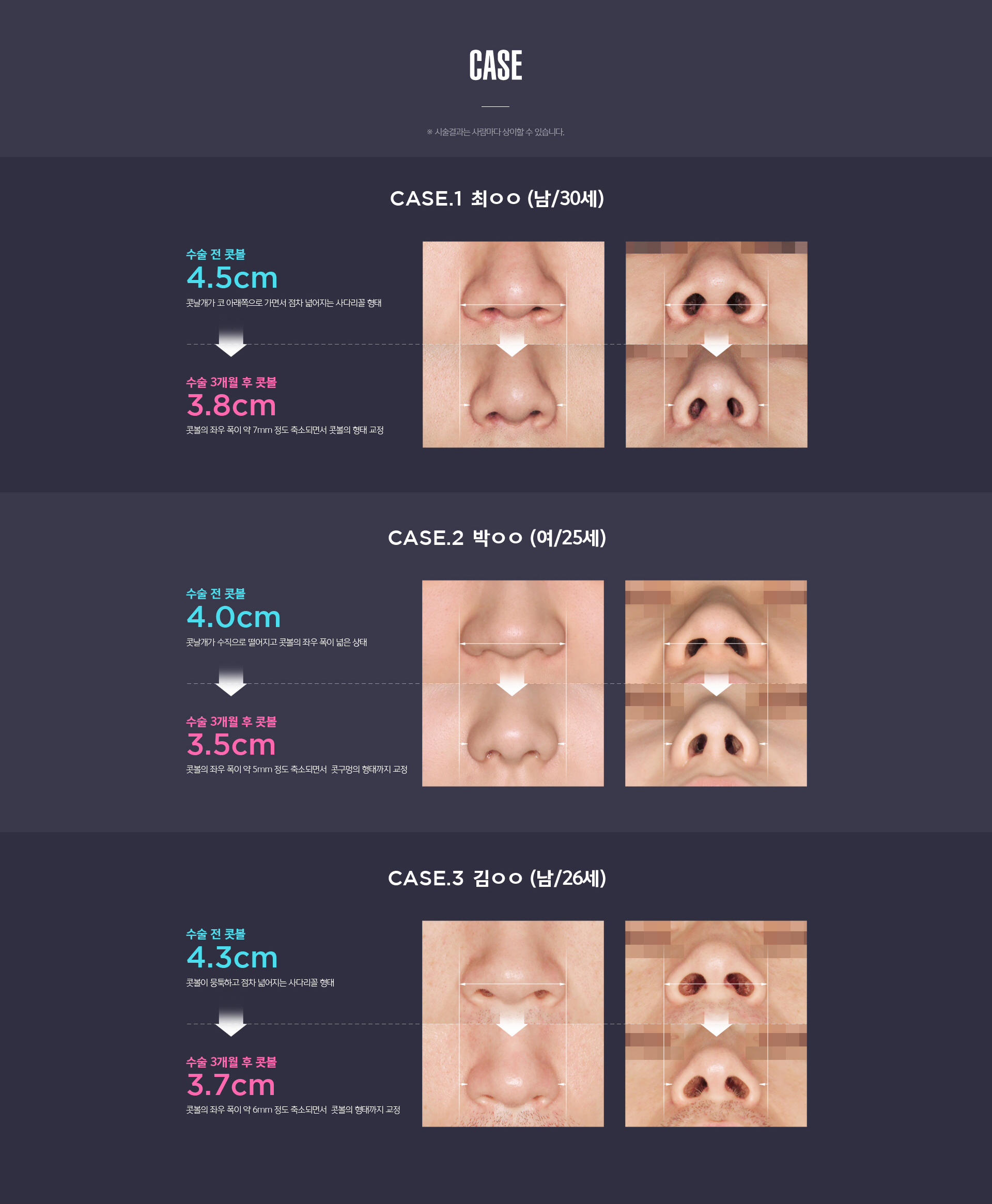 무흉콧볼이동술 적응증 - 넓은 콧볼, 큰 콧구멍, 웃을 때 벌어지는 콧볼, 좌우 비대칭 교정 사례