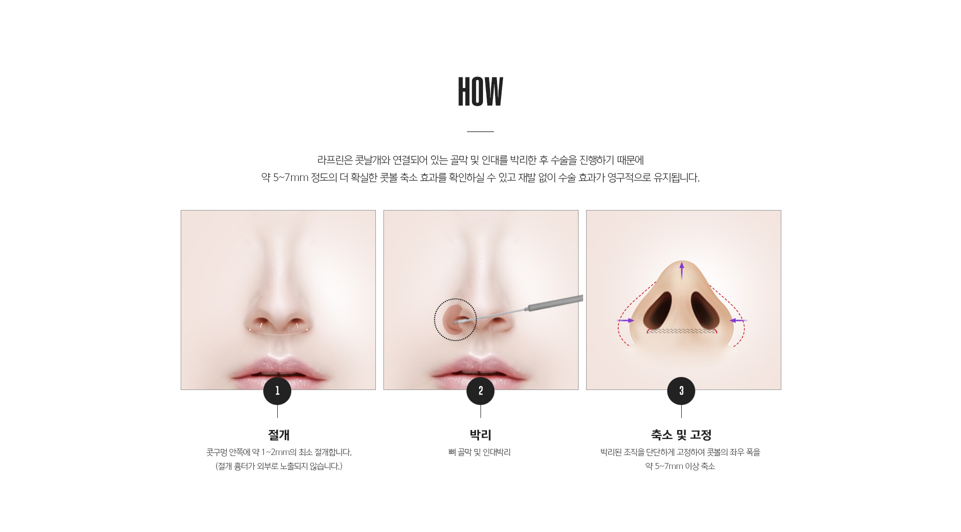 무흉콧볼이동술 회복과정 - 수술 후 붓기, 실밥 제거, 일상복귀 시점 및 주의사항 안내