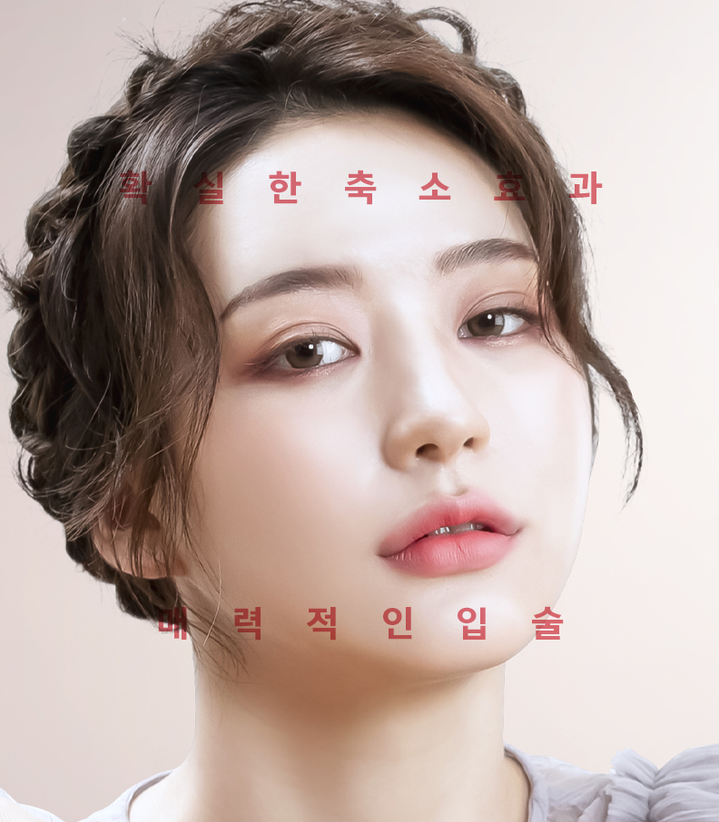 인중축소성형 전후 비교 사례 1 - 1.5cm 이상 긴 인중을 자연스럽게 줄인 결과