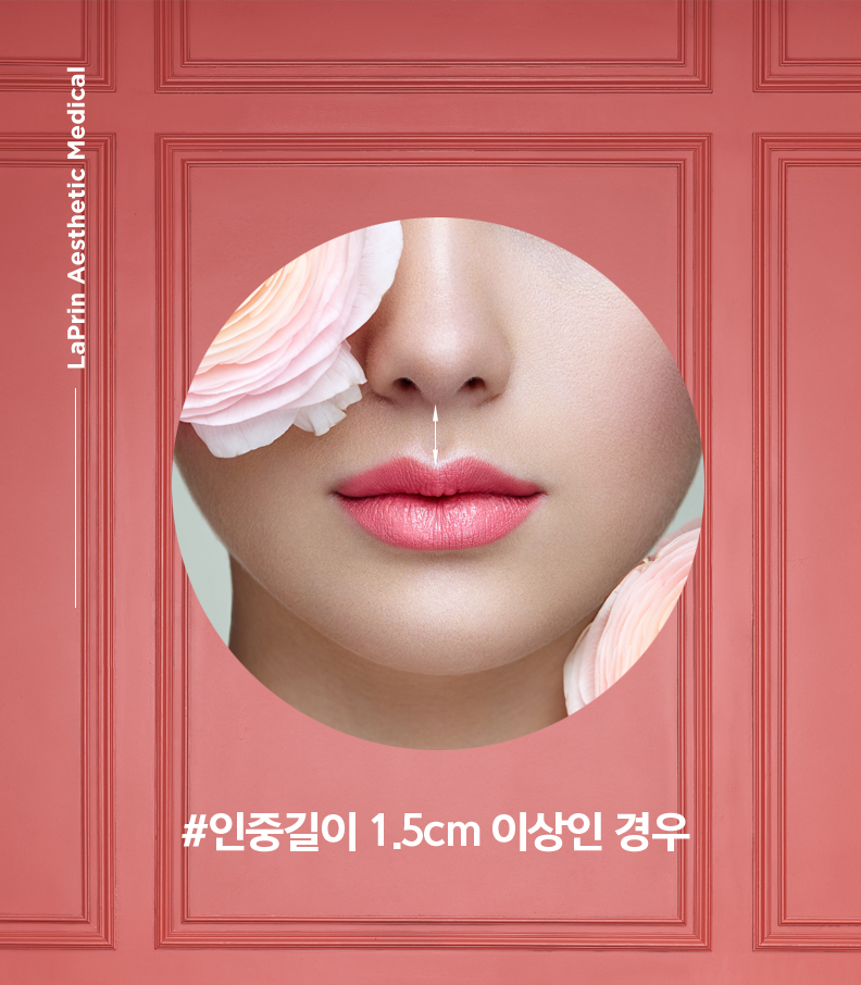인중축소성형 전후 비교 사례 2 - 인중 단축과 윗입술 리프팅 동시 교정