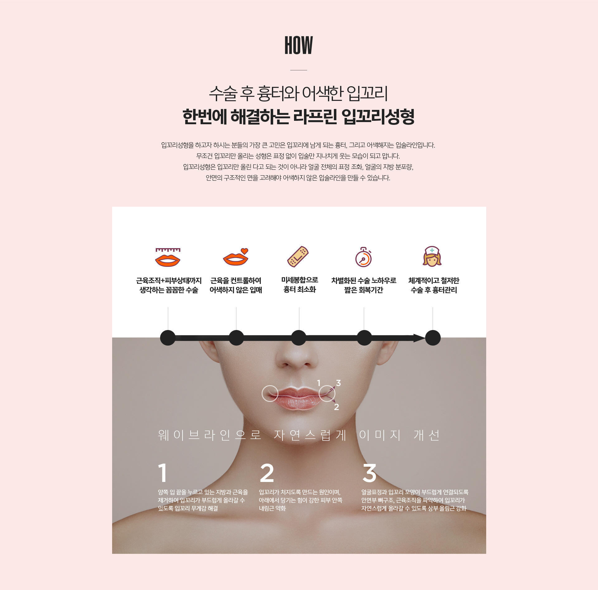 입꼬리성형 수술 방법 - 구각하제근 약화, 올림근 강화, 웨이브라인 디자인 적용으로 자연스러운 미소 라인 형성