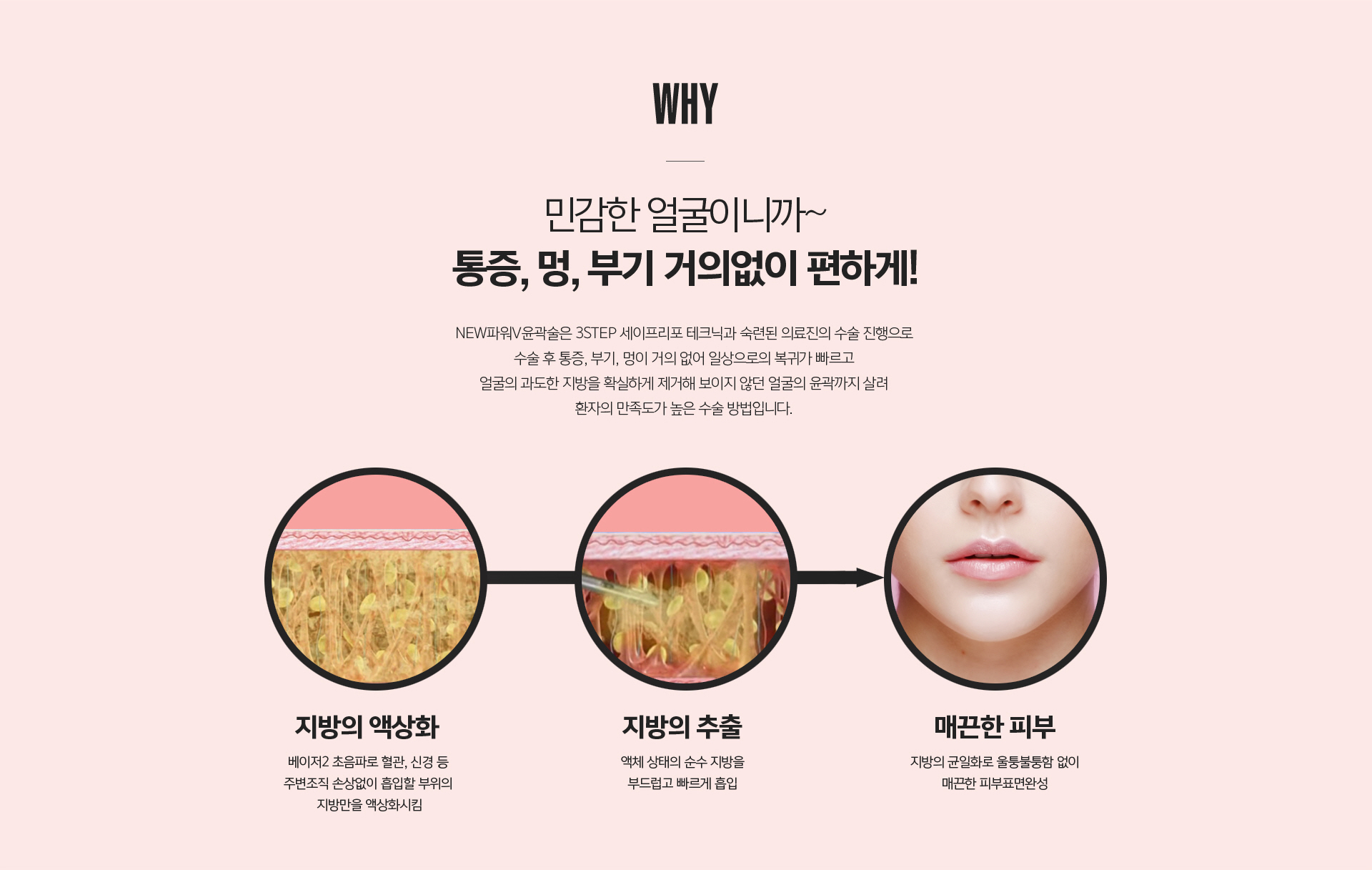 웨이브라인 입꼬리 개선 및 VECTRA XT 3D 수술 전 시뮬레이션 시스템