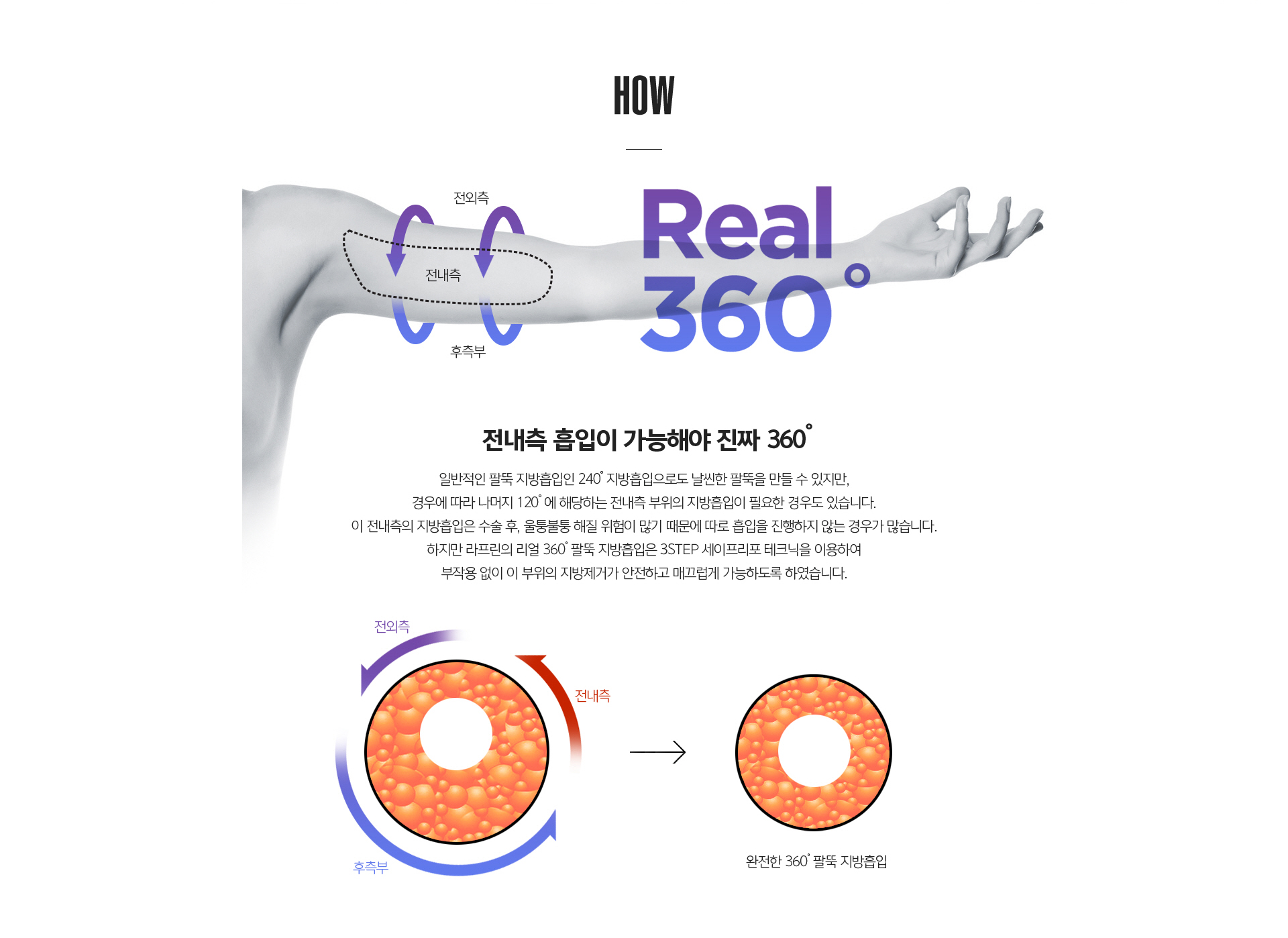 팔뚝 지방흡입 적은 출혈과 흉터 비교